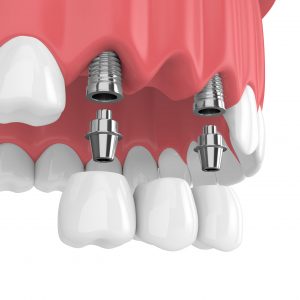 Tulsa Invisalign
