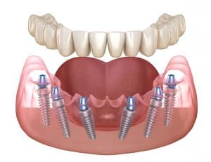 Tulsa Family Dentist